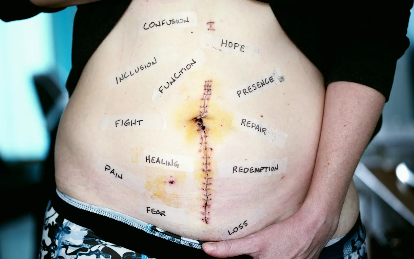 The evidence for acupuncture here is of low certainty, and we say so