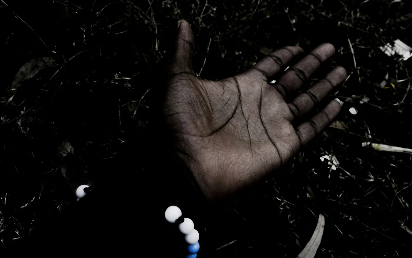 Acupuncture is conditionally recommended for hand osteoarthritis in US guidelines