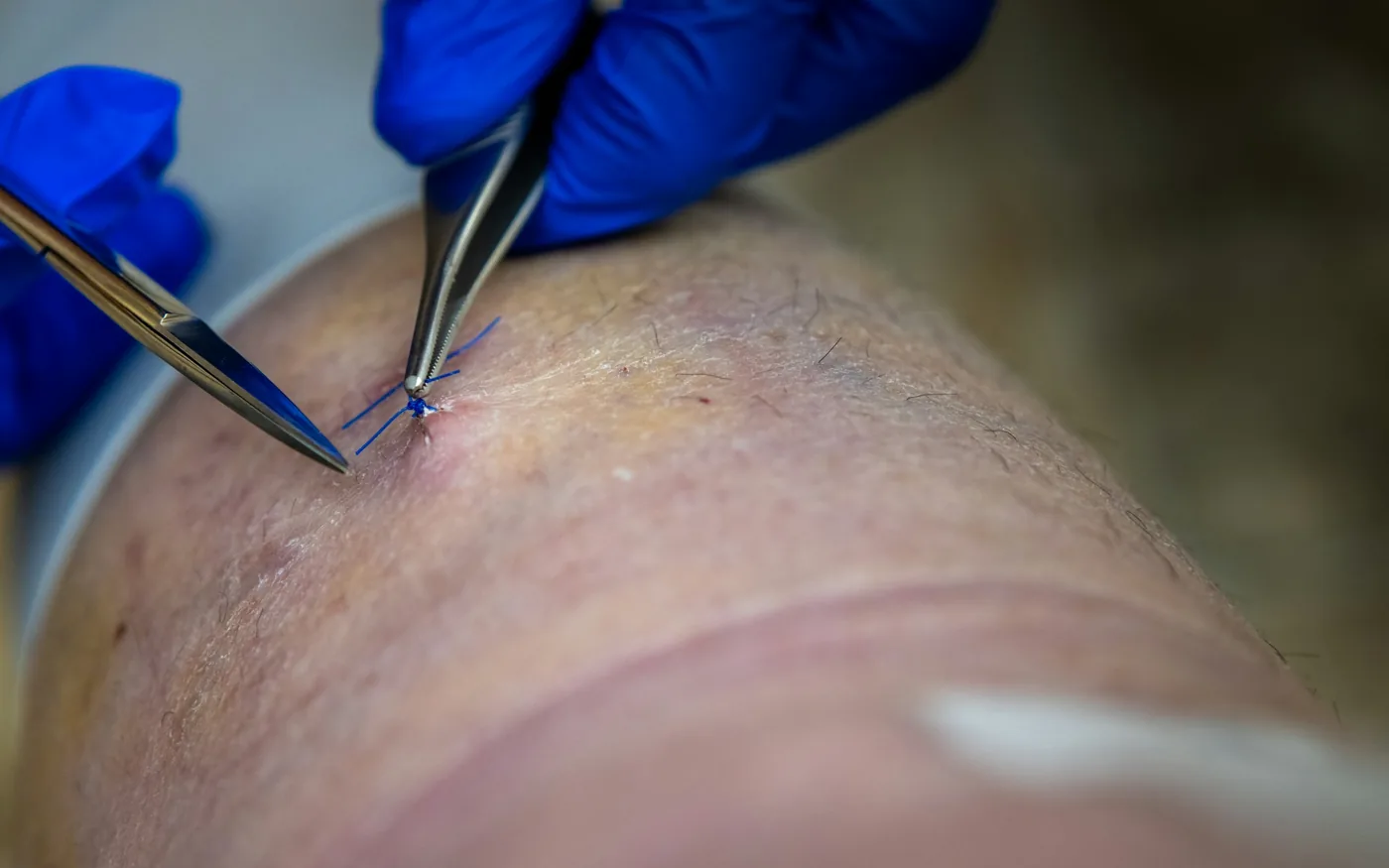 Needling eases the muscular tension around the joint while the strengthening works