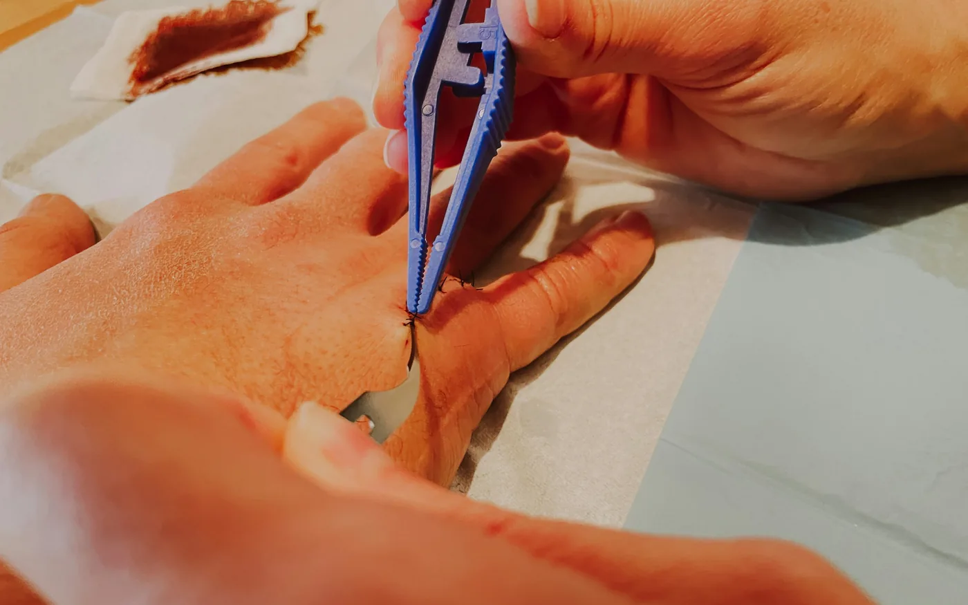Needles are far finer than the ones used for injections