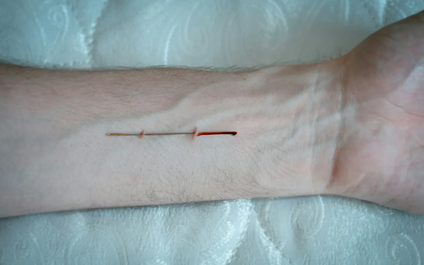 Needles placed along the forearm extensors rather than only at the elbow