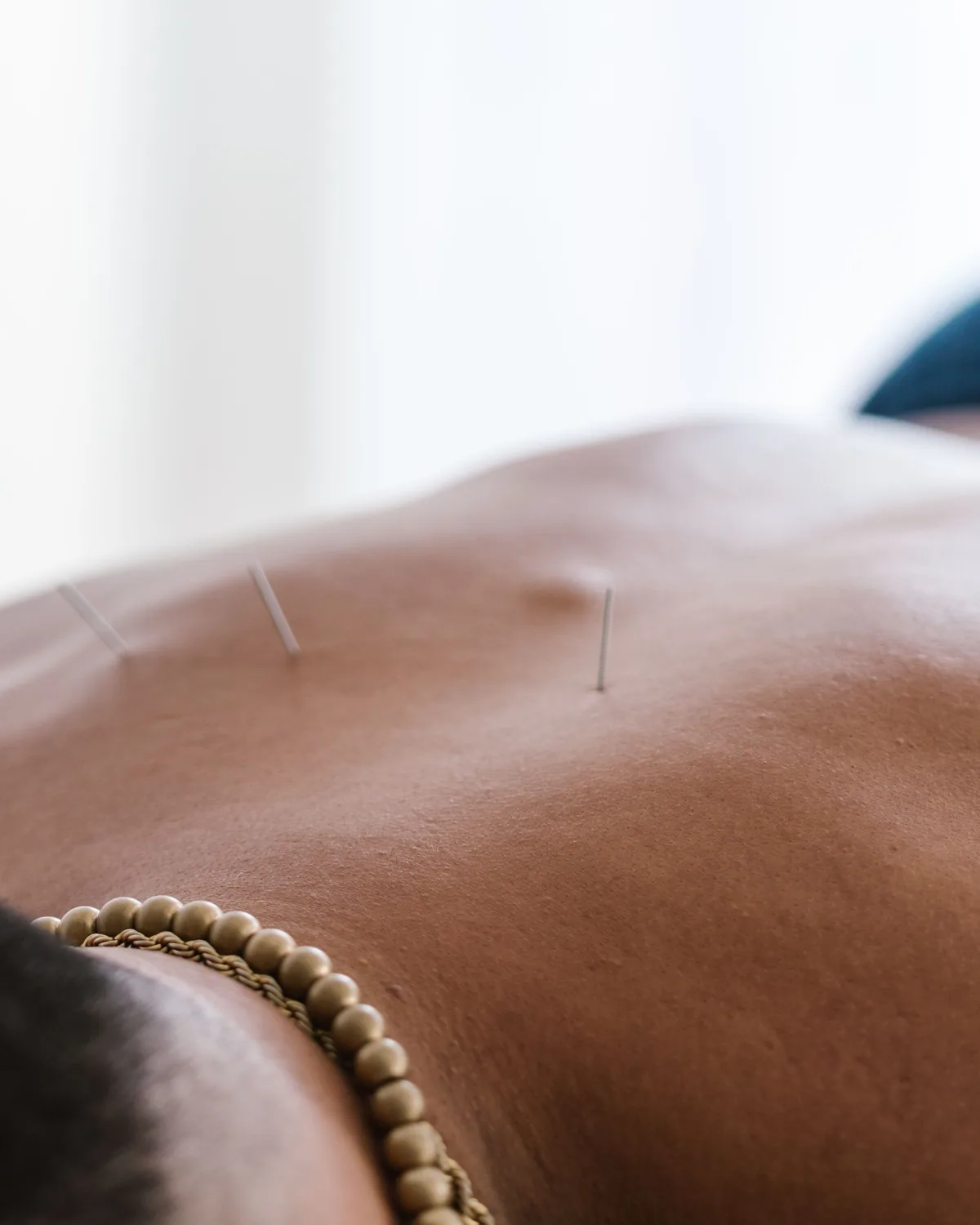 Fine acupuncture needles placed along a person&rsquo;s upper back during a treatment, in soft daylight.
