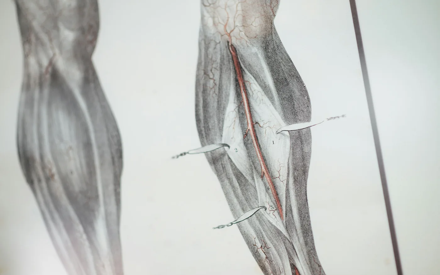 Acupuncture selects points from a traditional map of the body