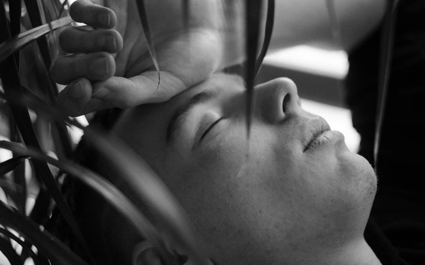 Needles placed around the jaw, temple and cheek