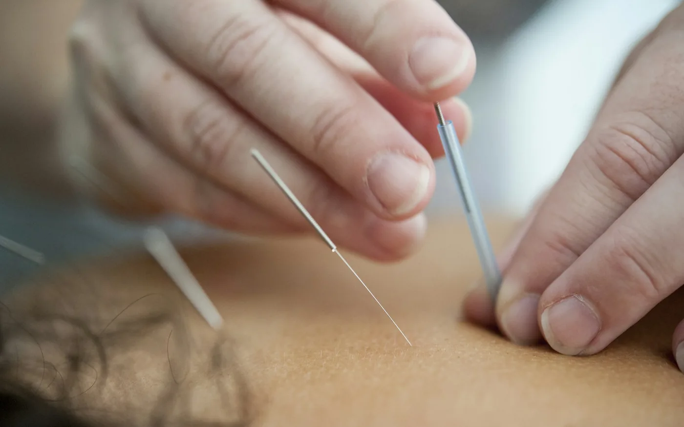 Acupuncture uses fine needles at specific points
