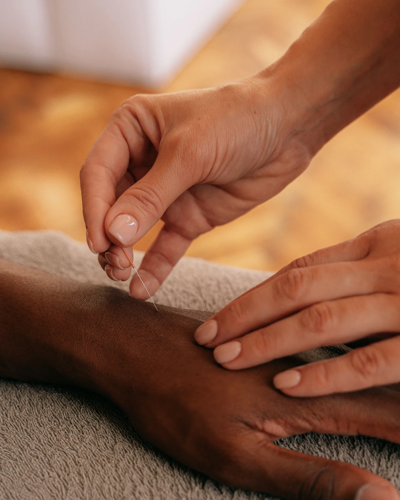 A practitioner&rsquo;s hands gently placing a fine acupuncture needle in a person&rsquo;s forearm, which rests on a soft towel.