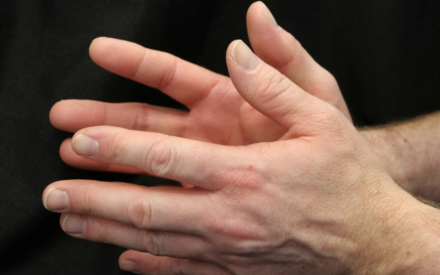 Pain on the thumb side of the wrist rather than at the thumb joint itself