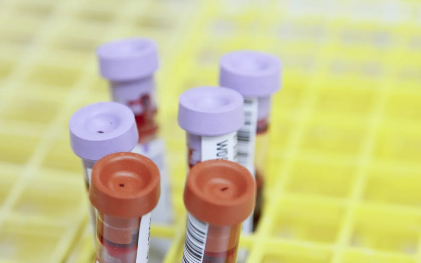 Checking ferritin is the single most useful first step