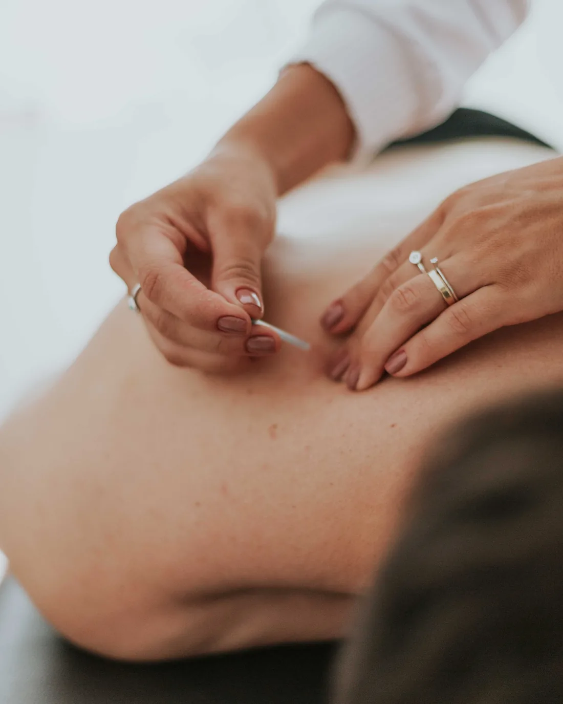 A practitioner placing a fine acupuncture needle in a person&rsquo;s upper back during a treatment.
